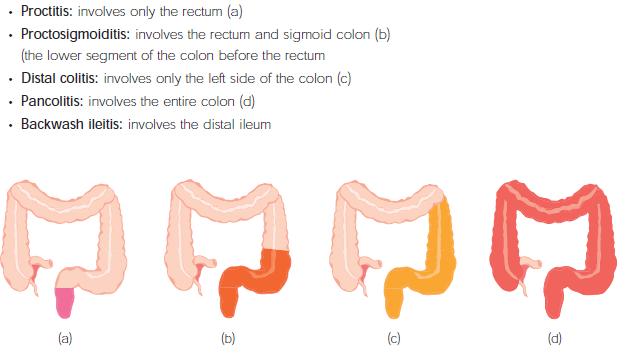 Diagram and pictures some graphic. you were warned ... diagram of colitis 